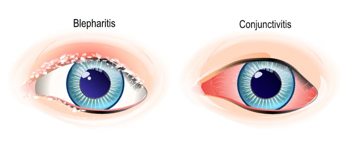 Blepharitis-conjunctivitis comparison