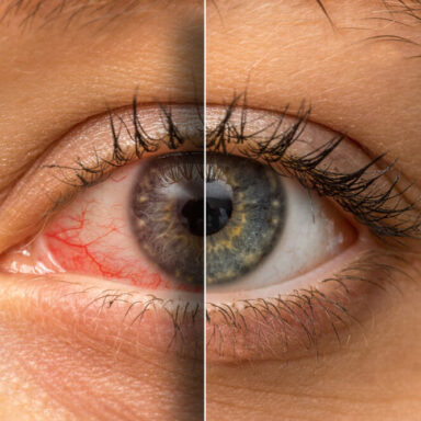 Image shows half eye bloodshot and red, the other half white and normal