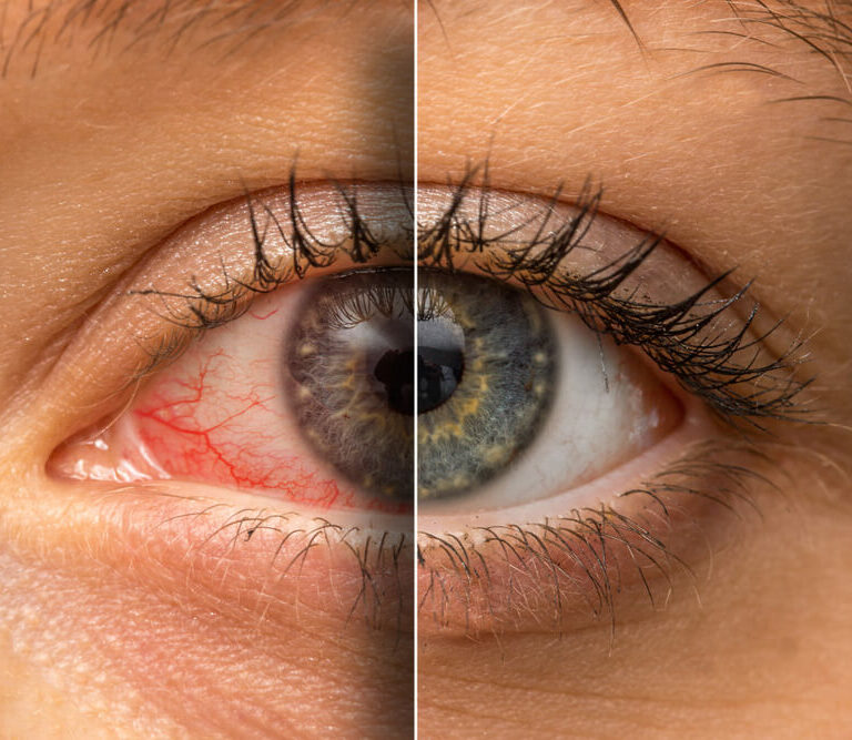 Image shows half eye bloodshot and red, the other half white and normal