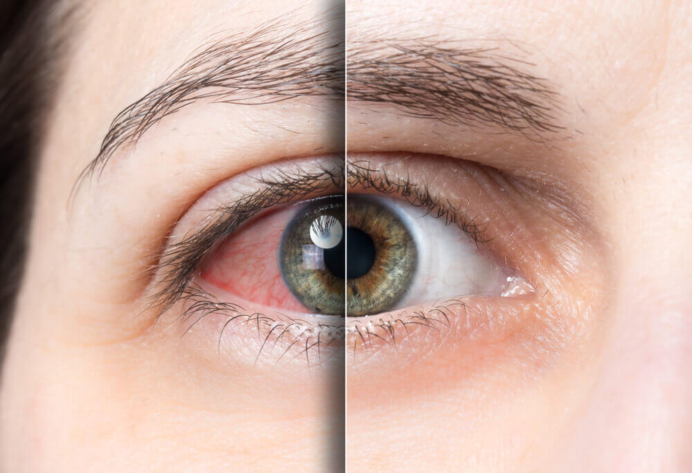 Image shows half eye bloodshot and red, the other half white and normal