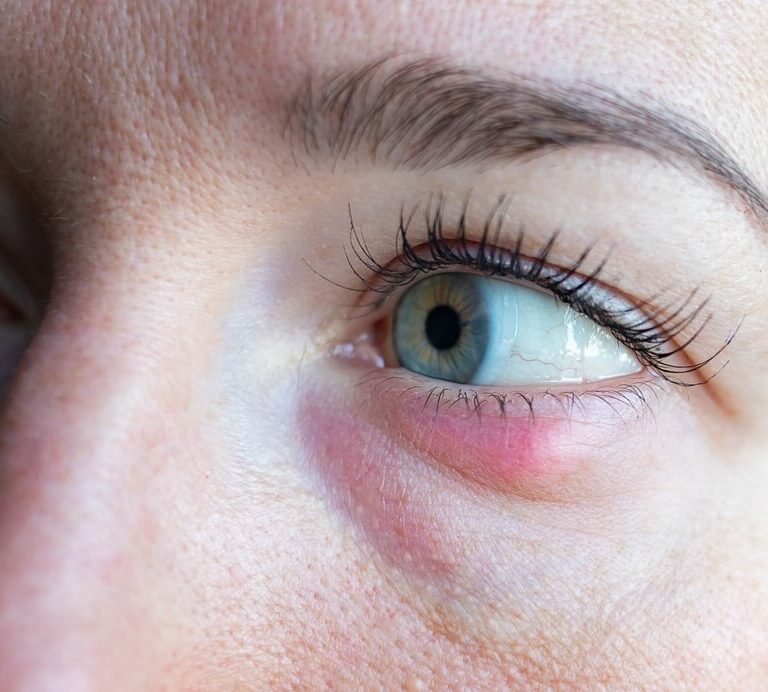 Image shows woman looking to side with red stye on lower eyelid