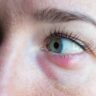 Image shows woman looking to side with red stye on lower eyelid